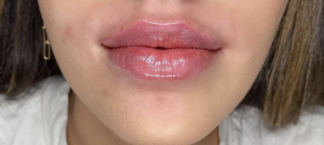 Lip filler after treatment