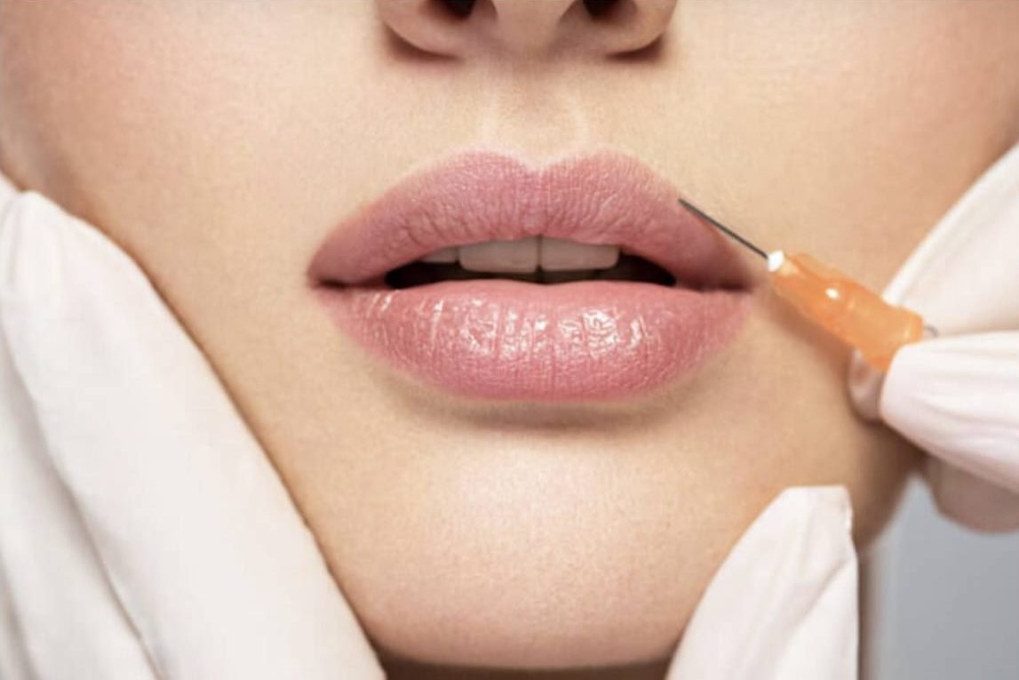 Lip filler injection performed with sterile gloves